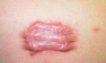 青岛哪家医院皮肤科好?推荐青岛皮肤病医院